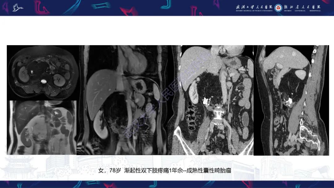 影像PPT - 【PPT】盆腹腔巨大占位性病变影像诊断-47