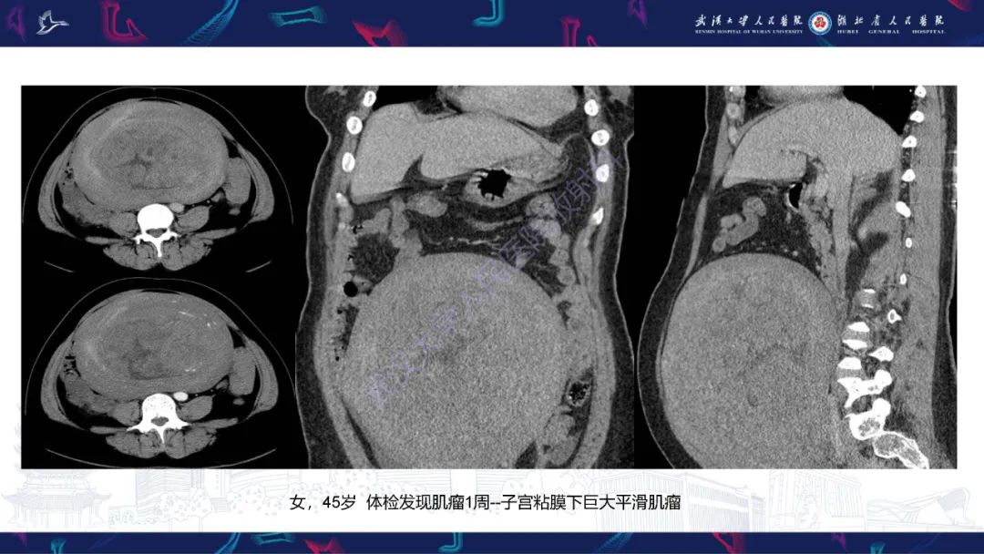 影像PPT - 【PPT】盆腹腔巨大占位性病变影像诊断-48