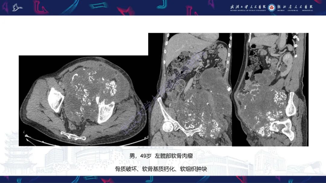 影像PPT - 【PPT】盆腹腔巨大占位性病变影像诊断-49