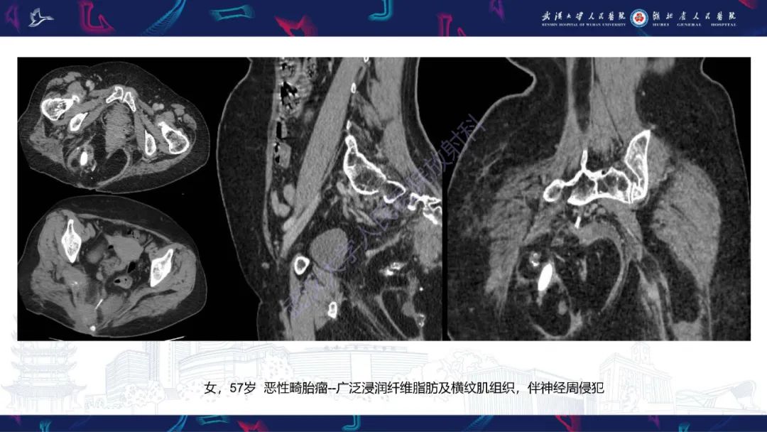 影像PPT - 【PPT】盆腹腔巨大占位性病变影像诊断-51