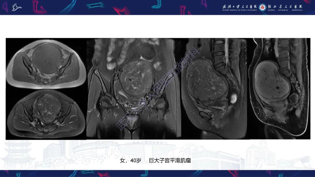 影像PPT - 【PPT】盆腹腔巨大占位性病变影像诊断-53