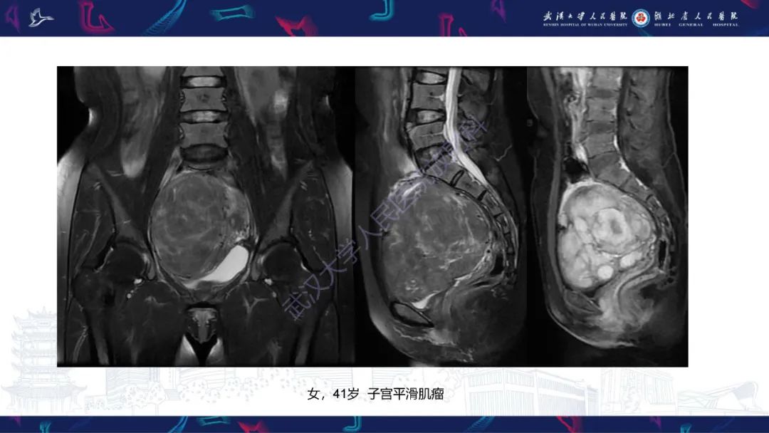 影像PPT - 【PPT】盆腹腔巨大占位性病变影像诊断-54