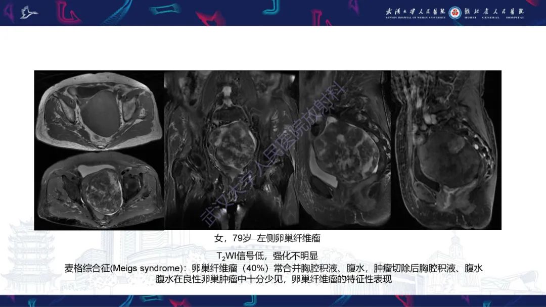 影像PPT - 【PPT】盆腹腔巨大占位性病变影像诊断-55