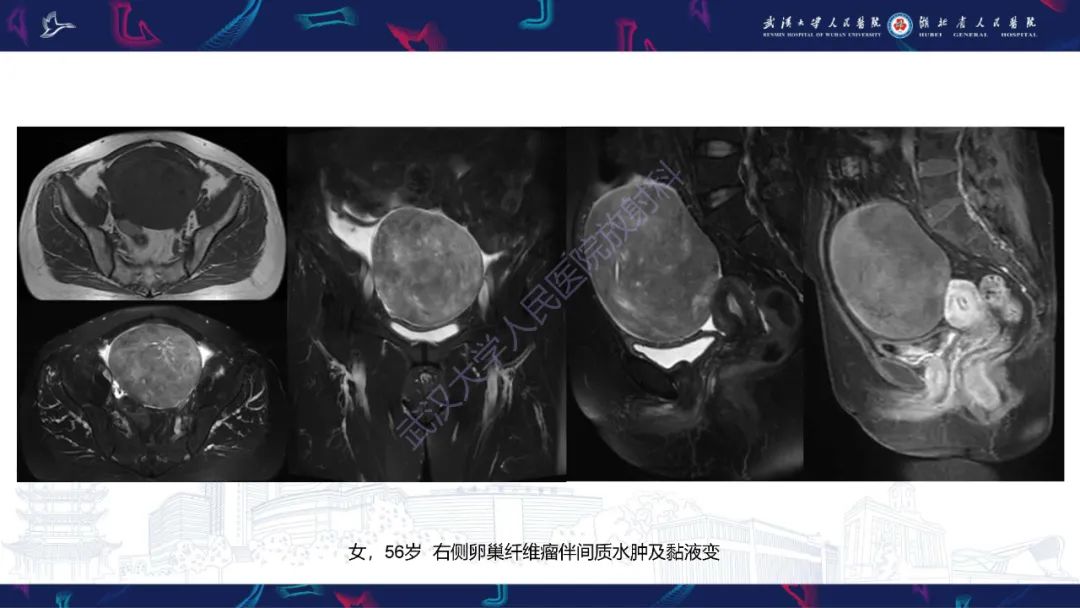影像PPT - 【PPT】盆腹腔巨大占位性病变影像诊断-56