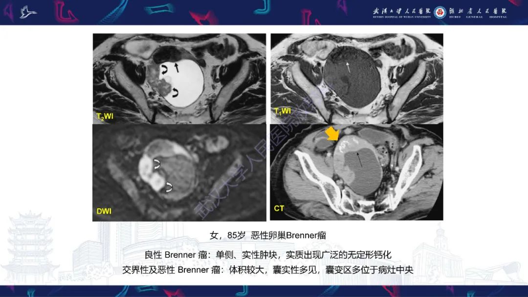 影像PPT - 【PPT】盆腹腔巨大占位性病变影像诊断-57