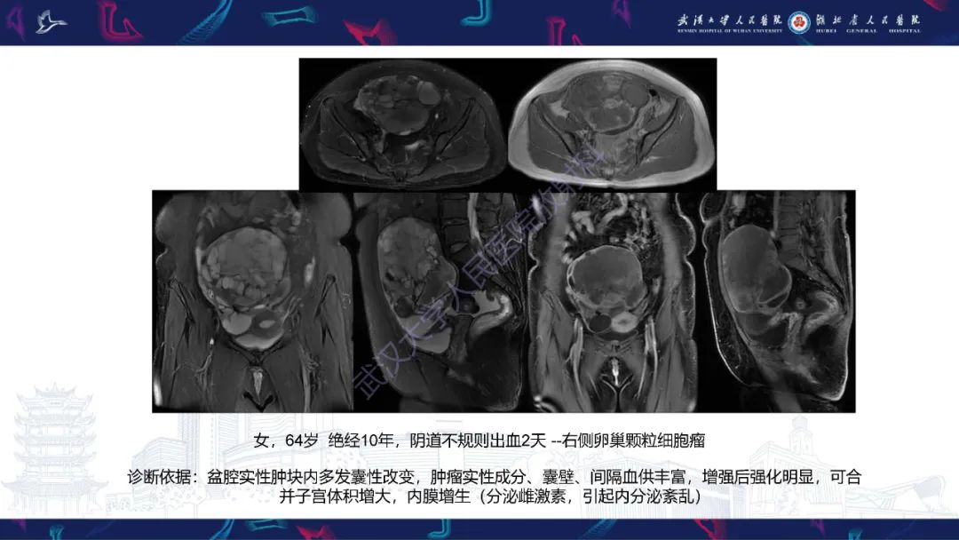 影像PPT - 【PPT】盆腹腔巨大占位性病变影像诊断-58