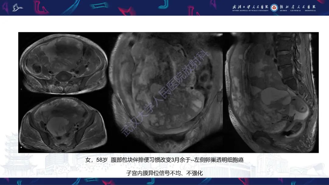影像PPT - 【PPT】盆腹腔巨大占位性病变影像诊断-59