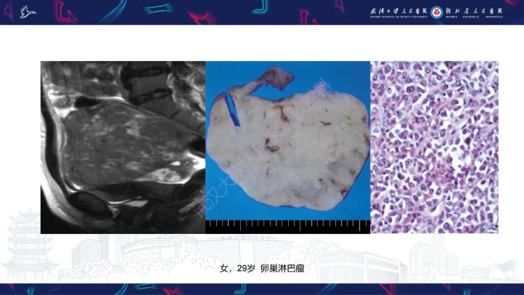 影像PPT - 【PPT】盆腹腔巨大占位性病变影像诊断-60