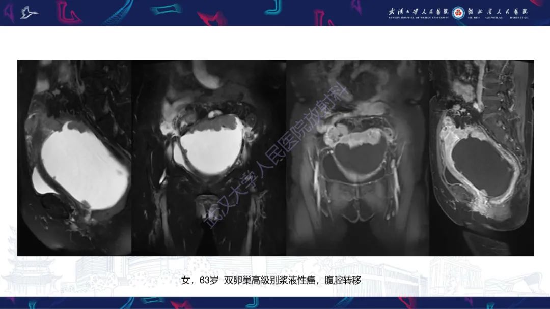 影像PPT - 【PPT】盆腹腔巨大占位性病变影像诊断-62