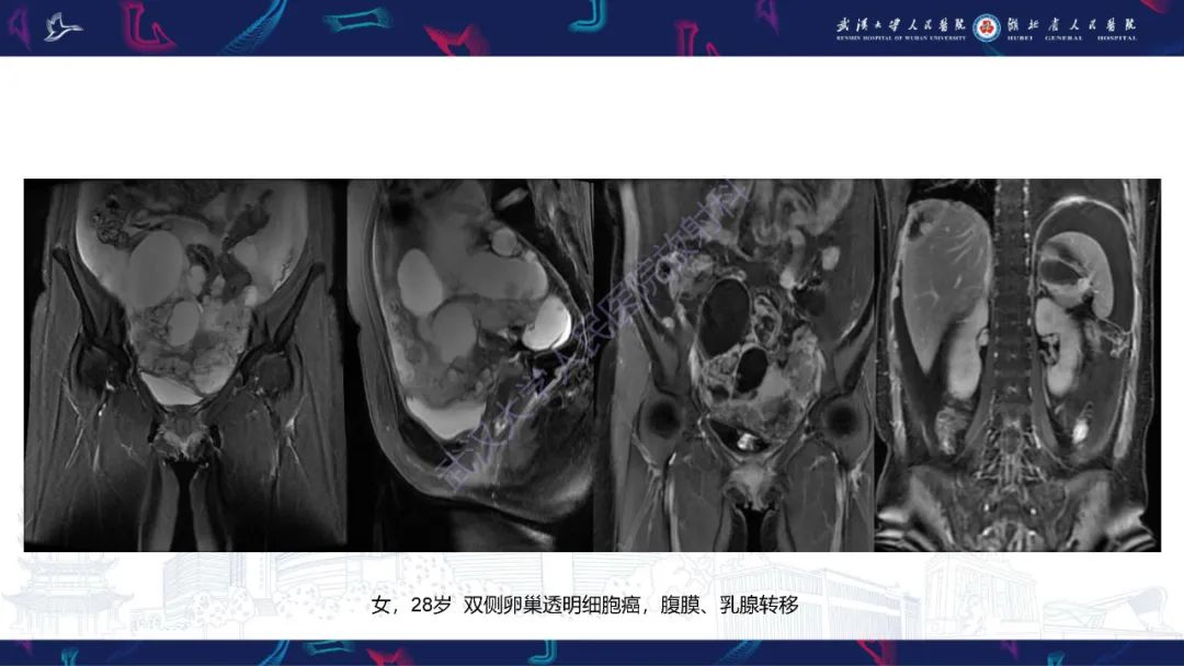 影像PPT - 【PPT】盆腹腔巨大占位性病变影像诊断-63