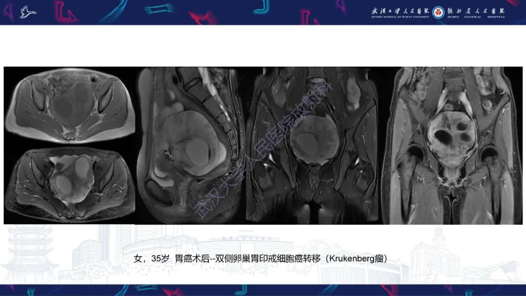 影像PPT - 【PPT】盆腹腔巨大占位性病变影像诊断-64