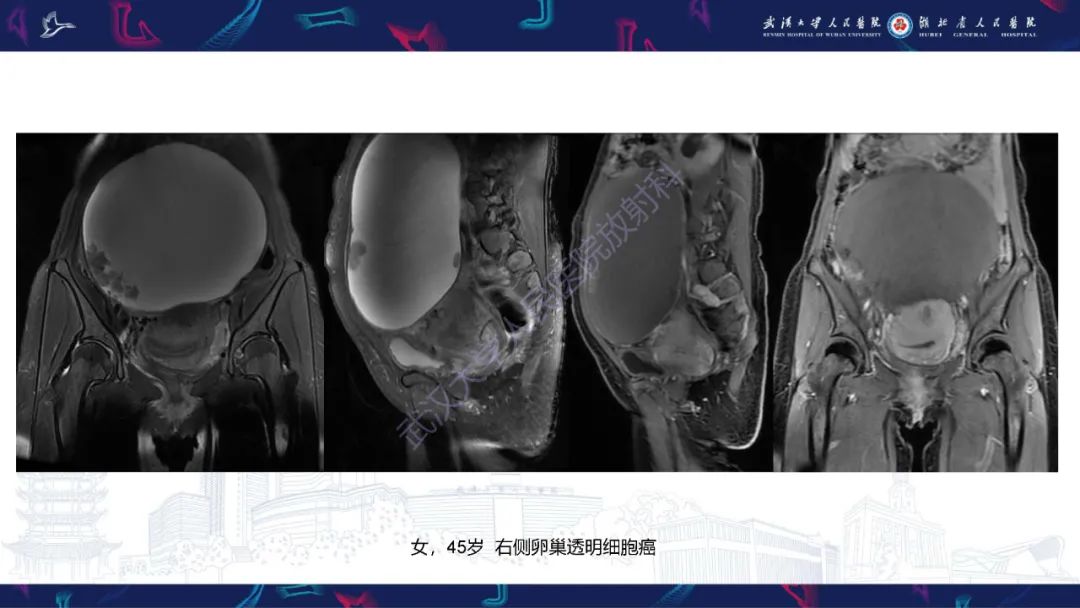 影像PPT - 【PPT】盆腹腔巨大占位性病变影像诊断-66
