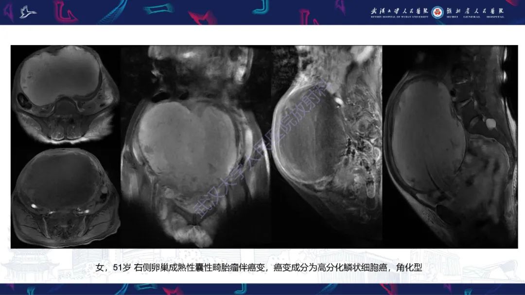 影像PPT - 【PPT】盆腹腔巨大占位性病变影像诊断-67