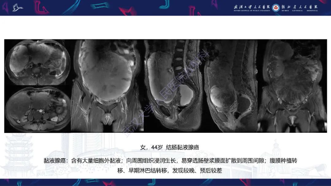 影像PPT - 【PPT】盆腹腔巨大占位性病变影像诊断-68