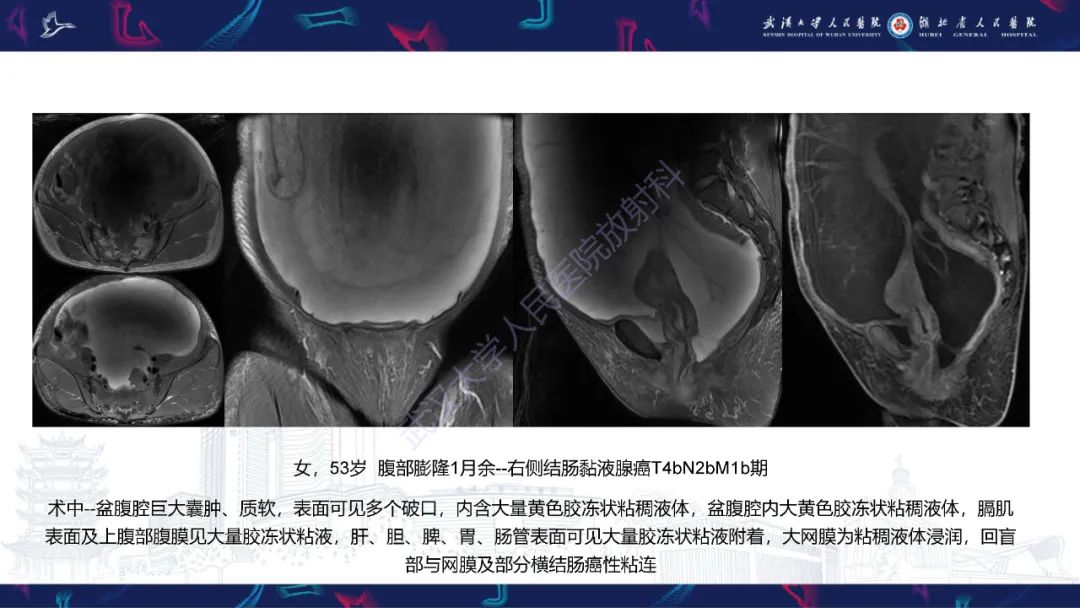 影像PPT - 【PPT】盆腹腔巨大占位性病变影像诊断-69