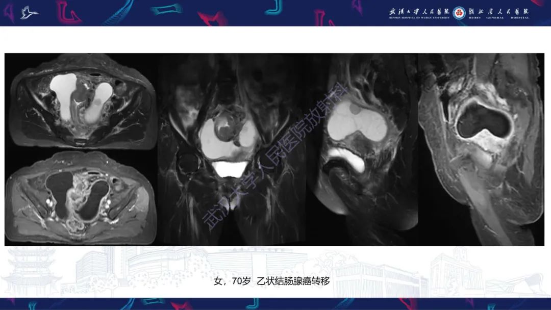 影像PPT - 【PPT】盆腹腔巨大占位性病变影像诊断-70