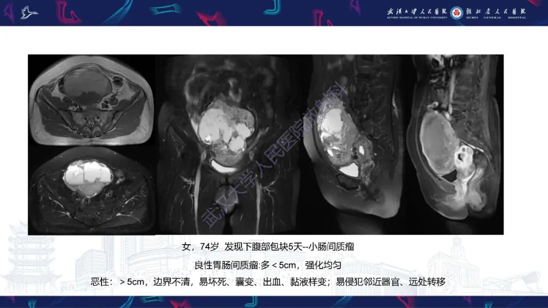 影像PPT - 【PPT】盆腹腔巨大占位性病变影像诊断-71