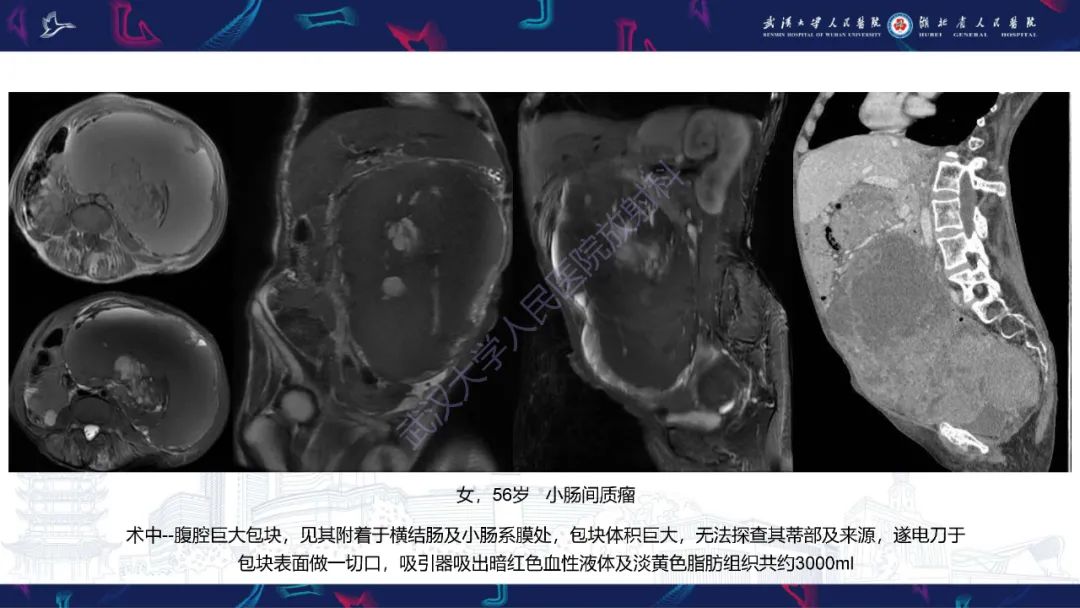 影像PPT - 【PPT】盆腹腔巨大占位性病变影像诊断-72