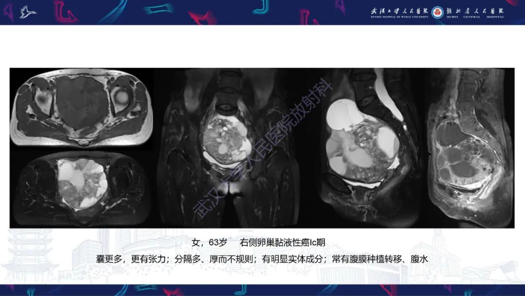 影像PPT - 【PPT】盆腹腔巨大占位性病变影像诊断-73