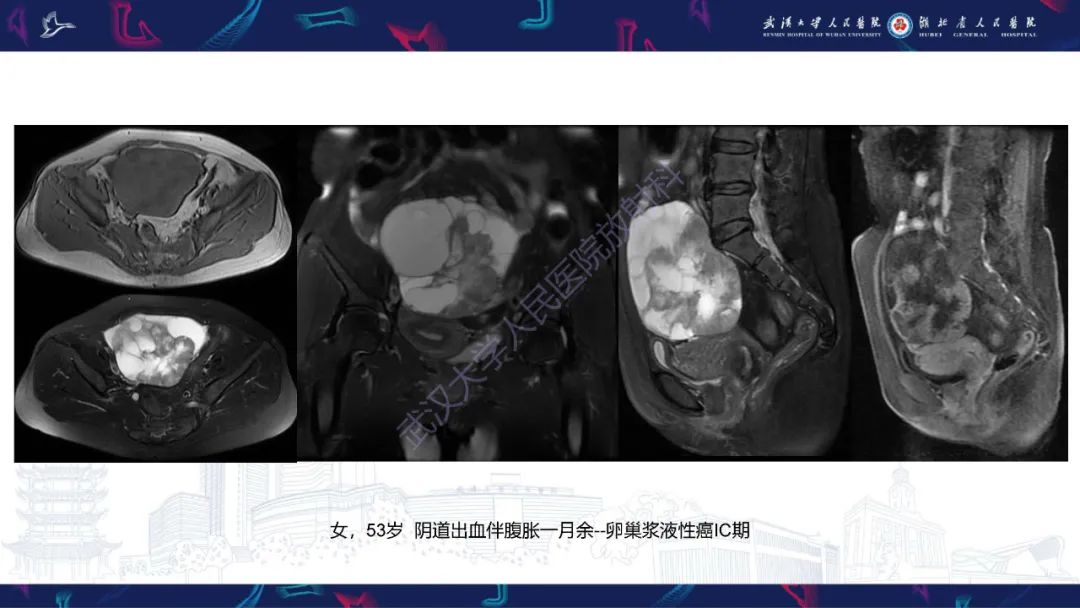 影像PPT - 【PPT】盆腹腔巨大占位性病变影像诊断-74