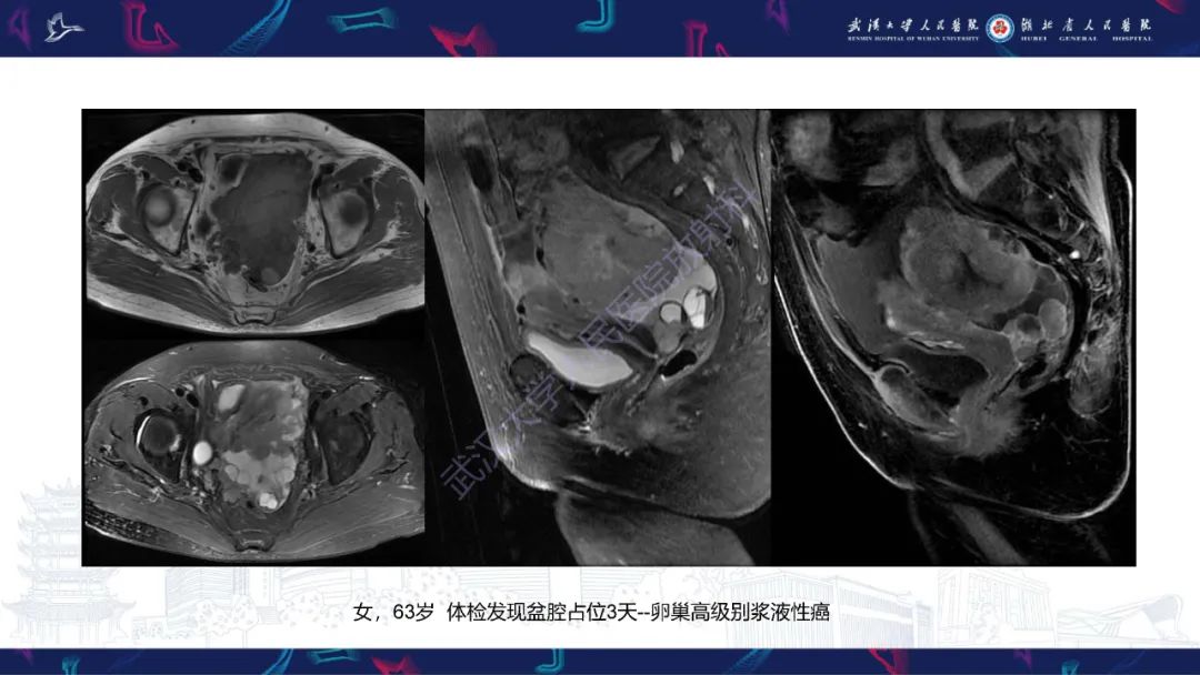 影像PPT - 【PPT】盆腹腔巨大占位性病变影像诊断-75