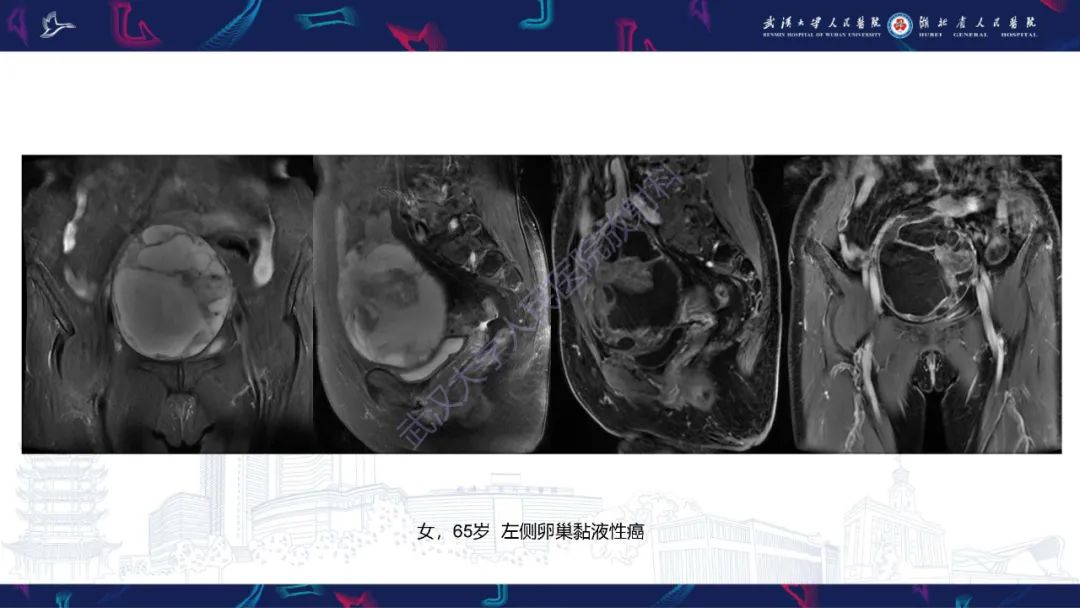 影像PPT - 【PPT】盆腹腔巨大占位性病变影像诊断-77