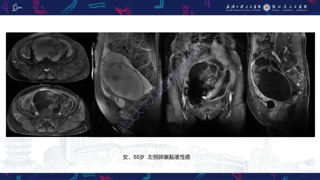 影像PPT - 【PPT】盆腹腔巨大占位性病变影像诊断-76