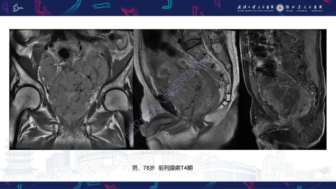 影像PPT - 【PPT】盆腹腔巨大占位性病变影像诊断-79