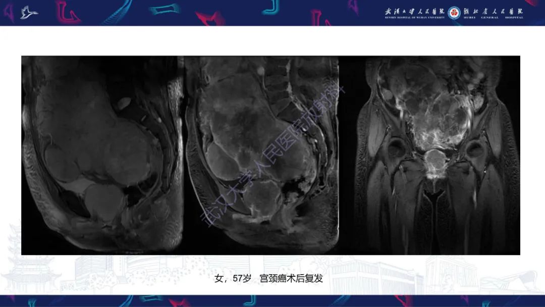 影像PPT - 【PPT】盆腹腔巨大占位性病变影像诊断-80