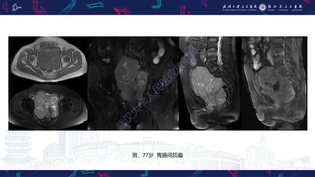 影像PPT - 【PPT】盆腹腔巨大占位性病变影像诊断-81