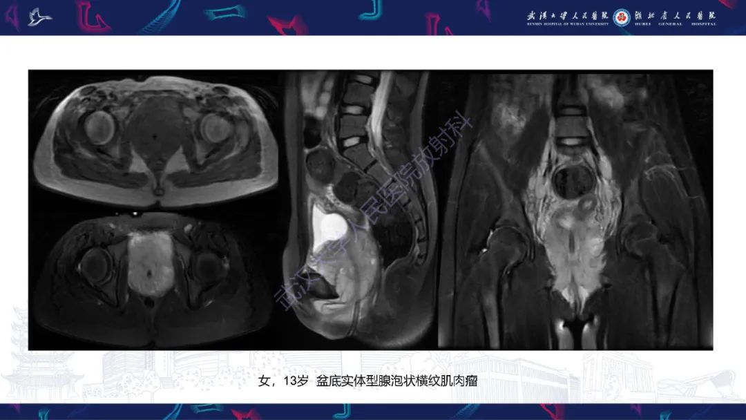 影像PPT - 【PPT】盆腹腔巨大占位性病变影像诊断-82