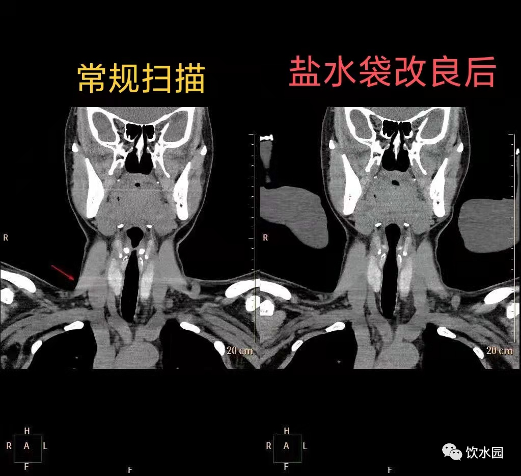 影像PPT - 盐水袋可去除射线束硬化伪影-3