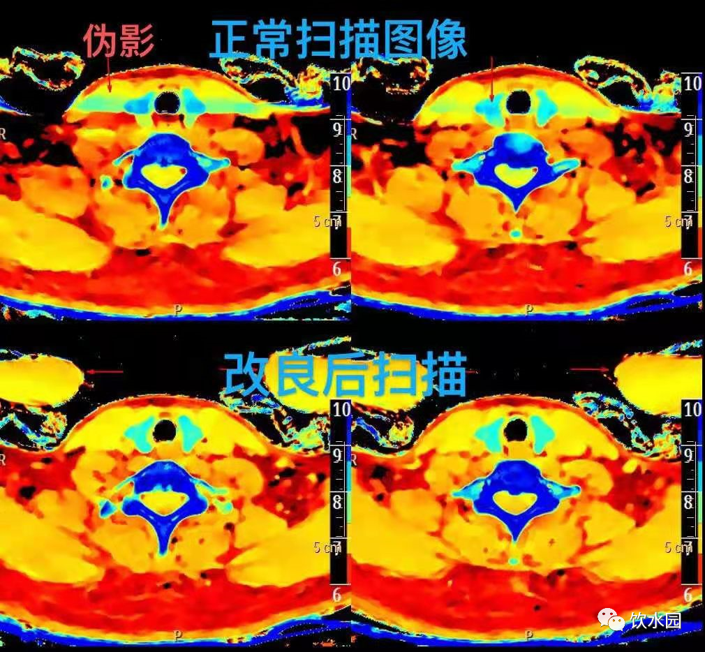影像PPT - 盐水袋可去除射线束硬化伪影-4