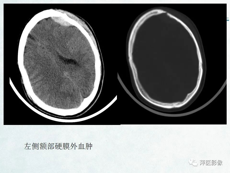 影像PPT - 【PPT】脑出血的分类及相关影像学表现-13