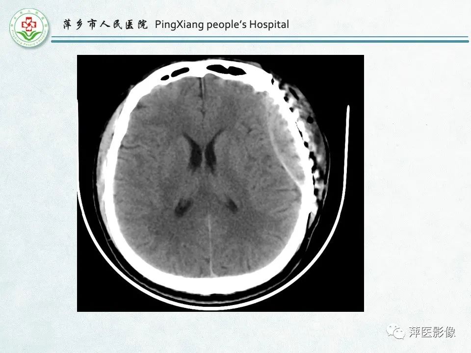 影像PPT - 【PPT】脑出血的分类及相关影像学表现-14