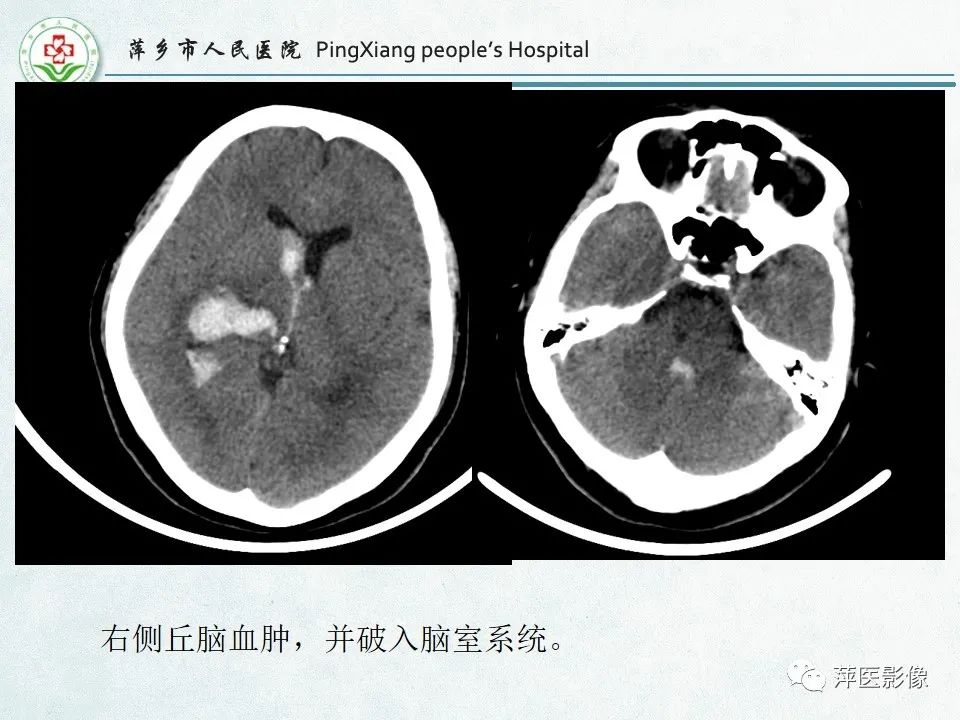 影像PPT - 【PPT】脑出血的分类及相关影像学表现-28