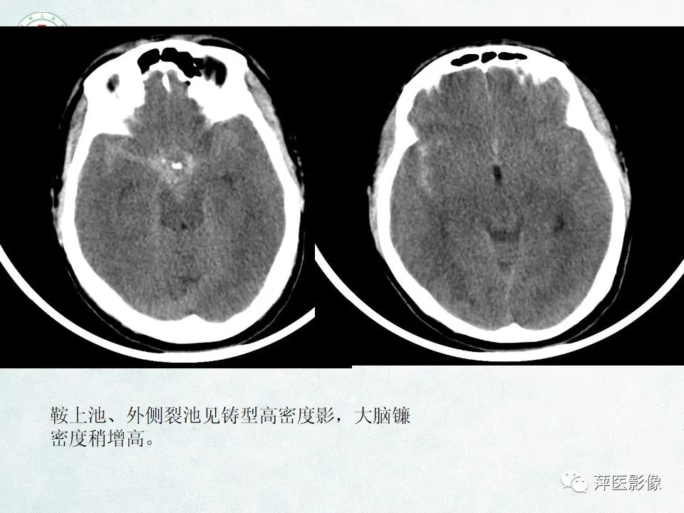 影像PPT - 【PPT】脑出血的分类及相关影像学表现-34