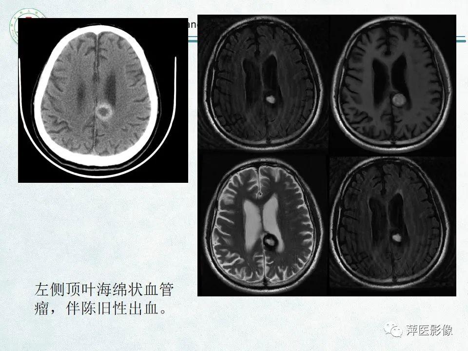 影像PPT - 【PPT】脑出血的分类及相关影像学表现-35