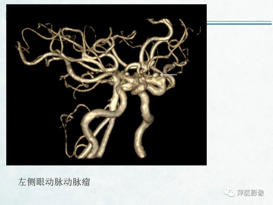 影像PPT - 【PPT】脑出血的分类及相关影像学表现-37