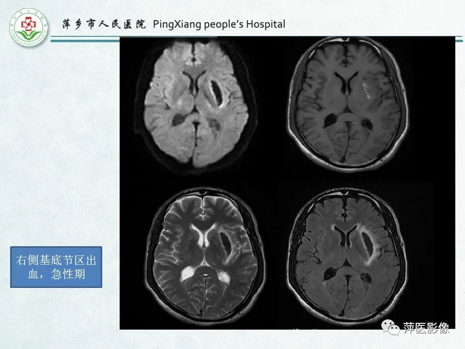 影像PPT - 【PPT】脑出血的分类及相关影像学表现-47