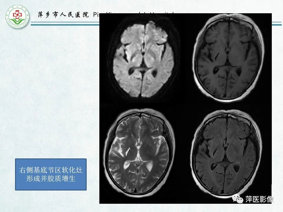 影像PPT - 【PPT】脑出血的分类及相关影像学表现-50