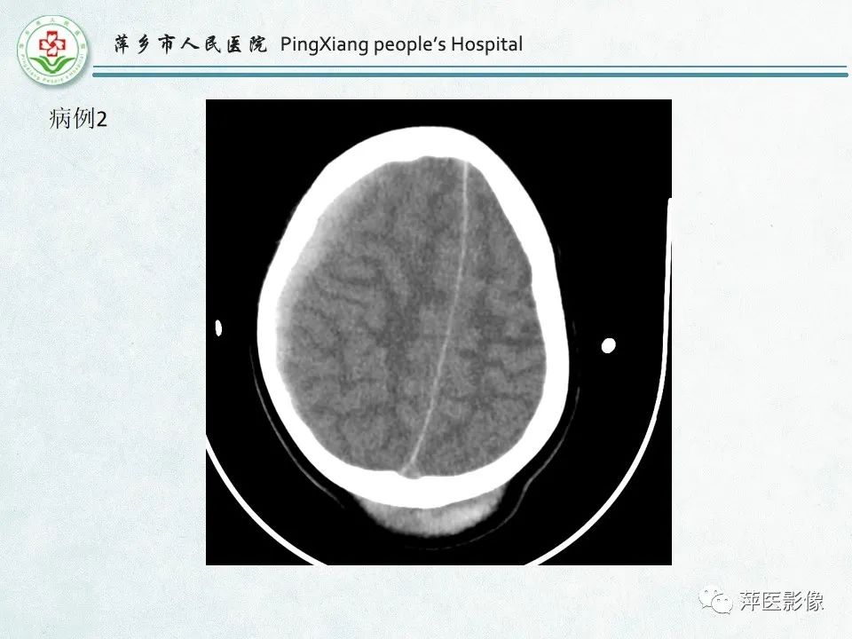 影像PPT - 【PPT】脑出血的分类及相关影像学表现-53