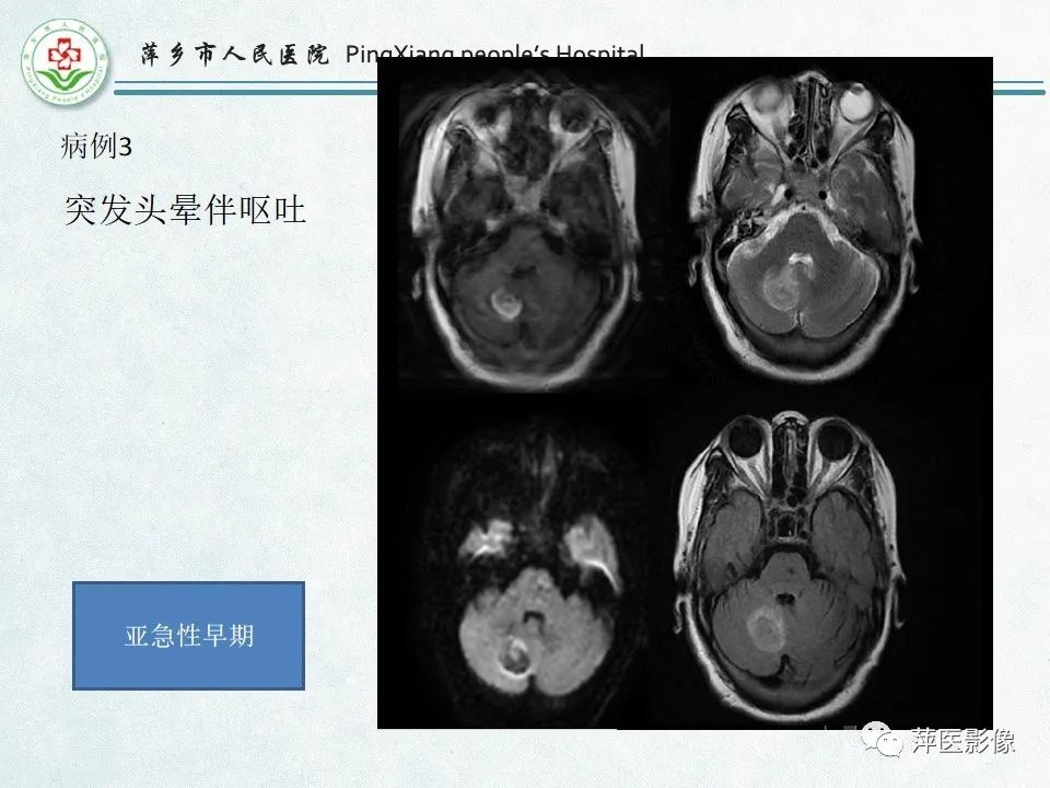 影像PPT - 【PPT】脑出血的分类及相关影像学表现-54