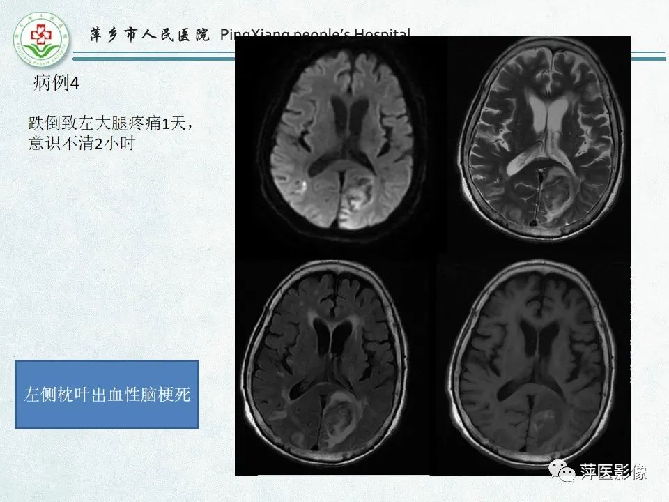影像PPT - 【PPT】脑出血的分类及相关影像学表现-55