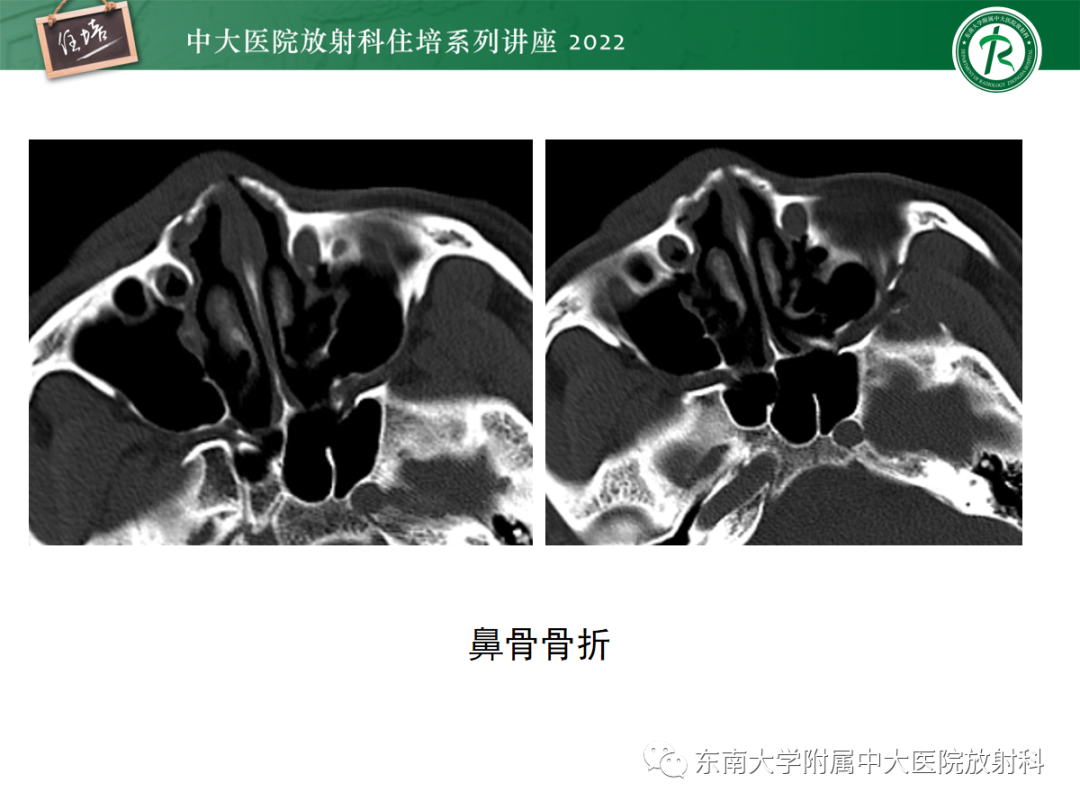 影像PPT - 【PPT】颌面部外伤的影像评估-15