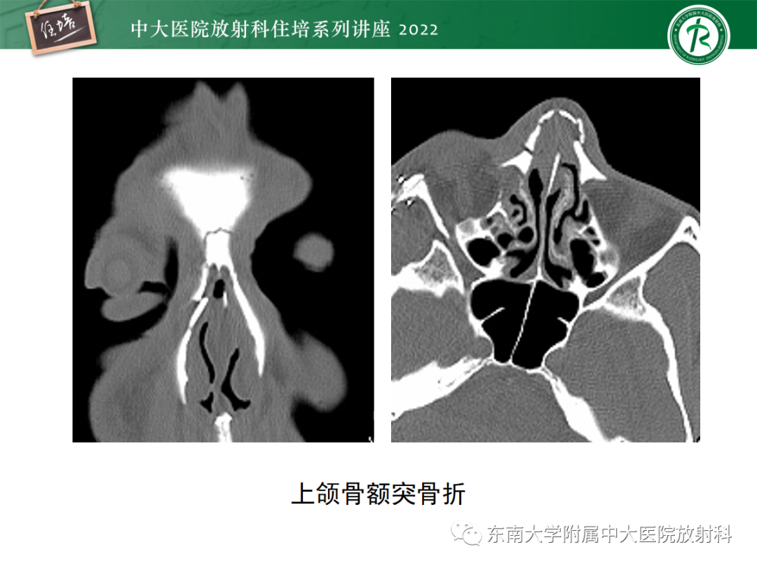 影像PPT - 【PPT】颌面部外伤的影像评估-16