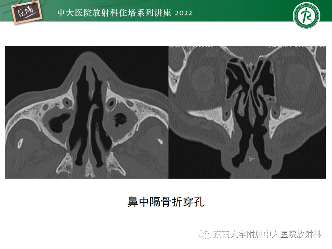 影像PPT - 【PPT】颌面部外伤的影像评估-17