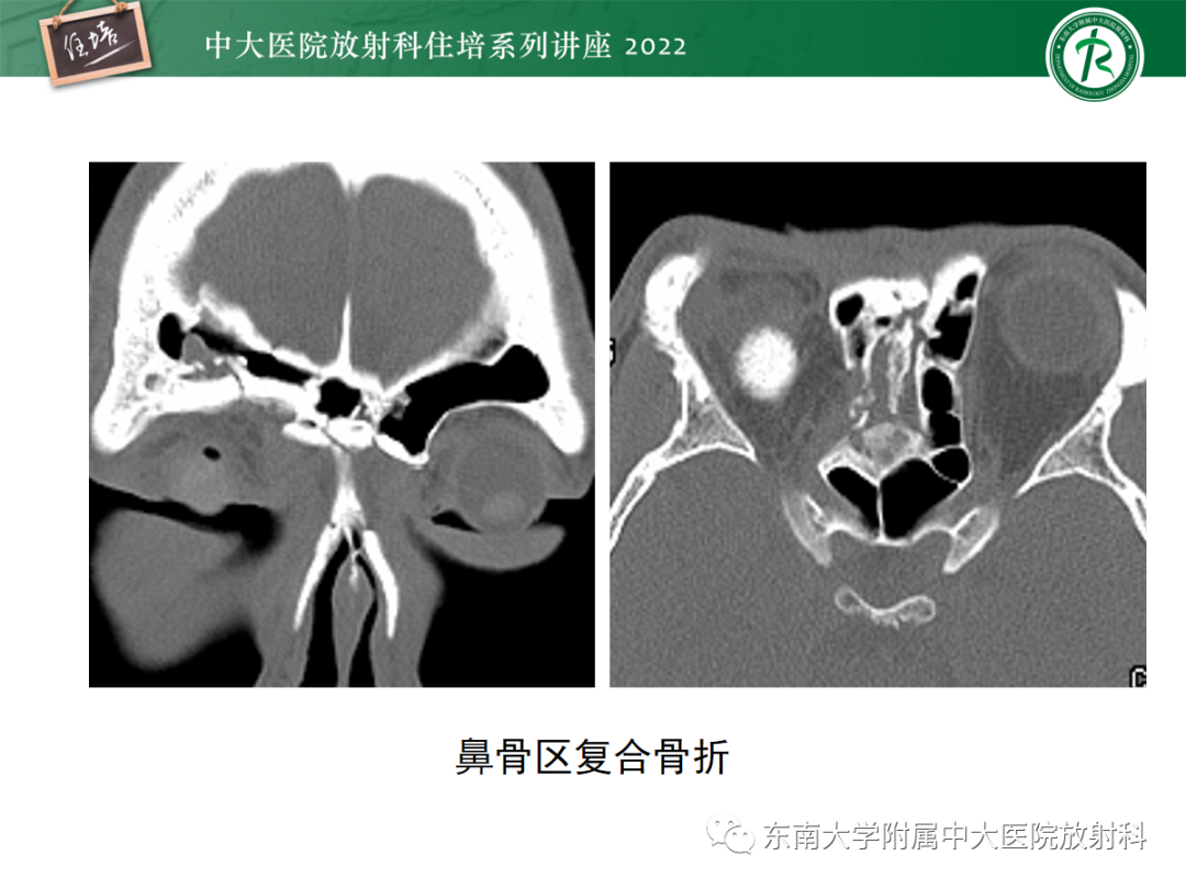 影像PPT - 【PPT】颌面部外伤的影像评估-18