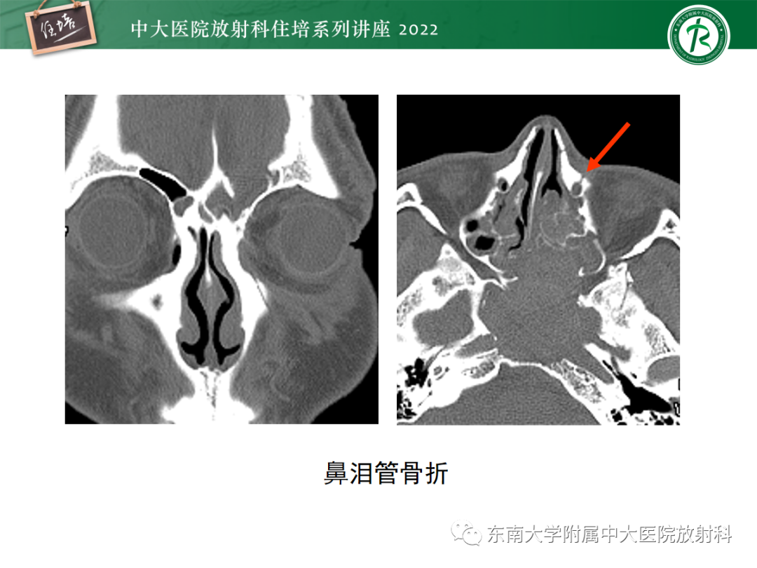 影像PPT - 【PPT】颌面部外伤的影像评估-19