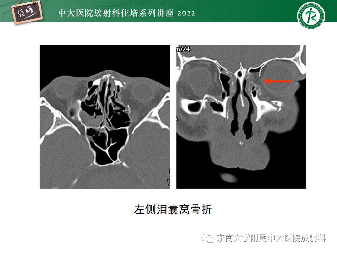 影像PPT - 【PPT】颌面部外伤的影像评估-20